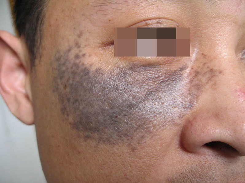 胎记术后应该怎么护理