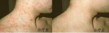 荨麻疹是怎么引起的