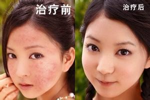 荨麻疹治疗新方法