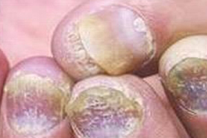灰指甲的发生如何预防?