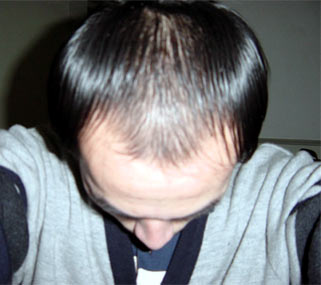 治疗脱发的方法
