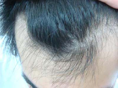 男性脱发常见的危害有哪些?